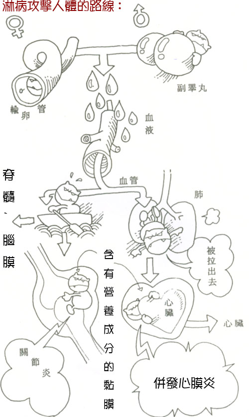 淋病發病過程