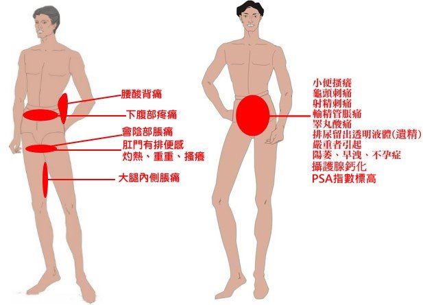 攝護腺炎