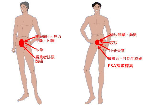 攝護腺肥大