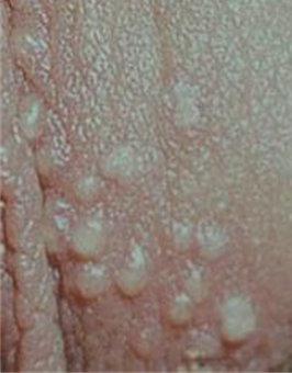 皰疹圖片 皰疹圖片