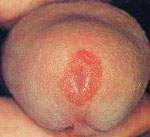 披衣菌圖示 披衣菌圖示