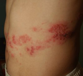 帶狀皰疹 帶狀皰疹