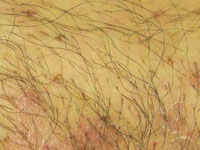 陰蝨圖片 陰蝨圖片